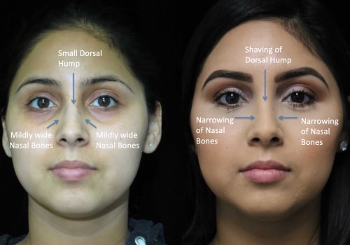 How to Find the Best Rhinoplasty Surgeon in Beverly Hills CA